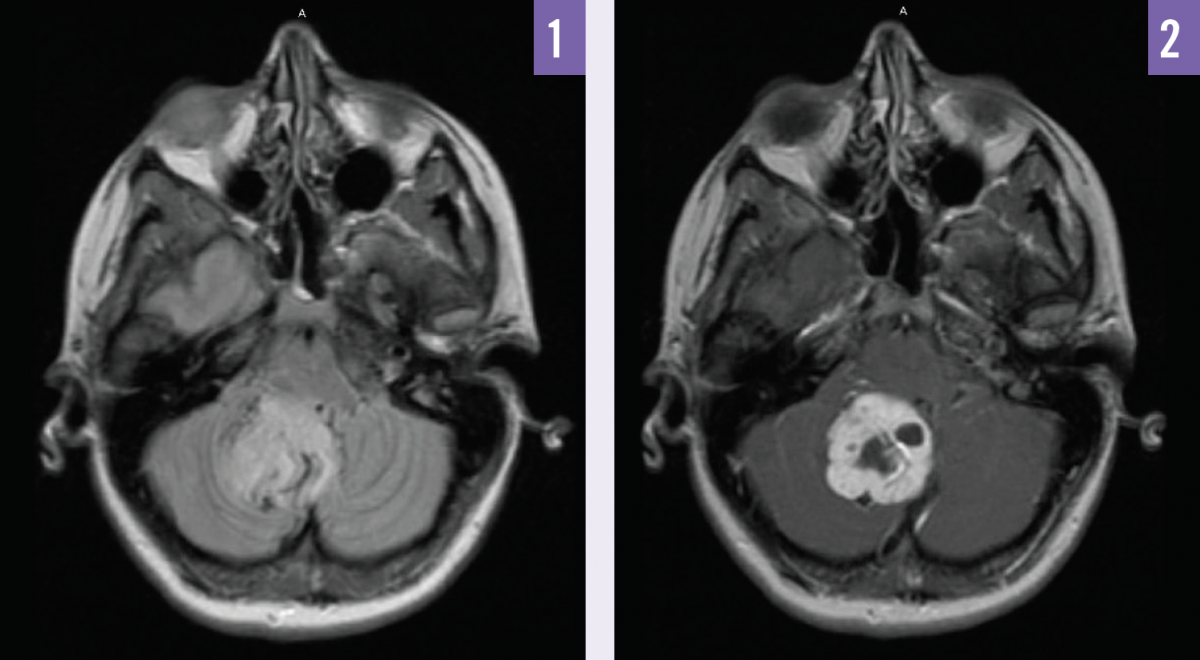 Sporadic Cerebellar Hemangioblastoma Consultant360